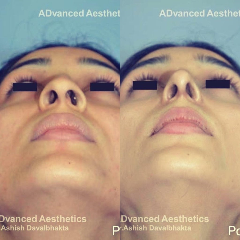 rhinoplasty italy